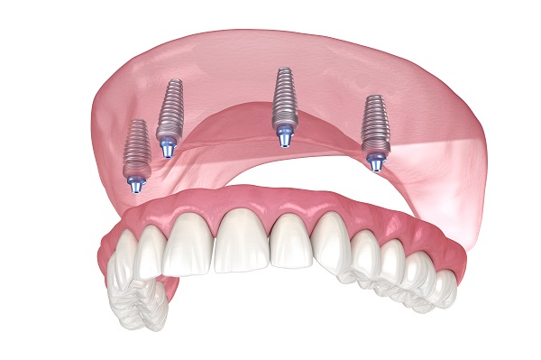 What Is The Procedure To Get All On  ® Like?