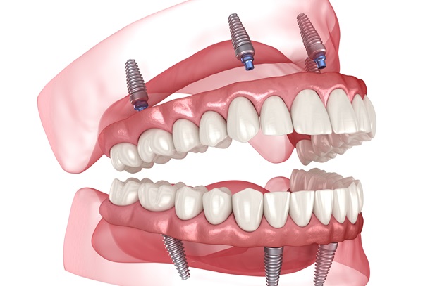 All On   : Replace All Bottom Teeth In A Day