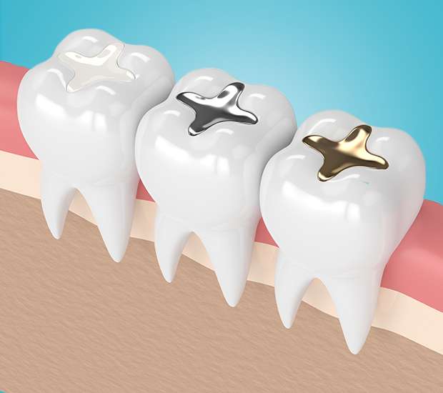 McLean Composite Fillings