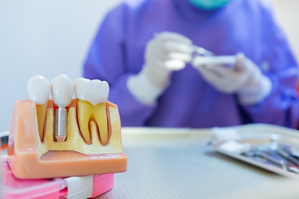 Replacing Missing Teeth &#    ; Timeline For Dental Implants