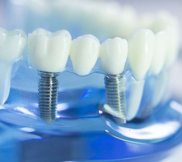 McLean Dental Implants