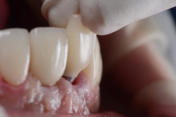 An Overview Of Implant Dentistry For Tooth Replacement