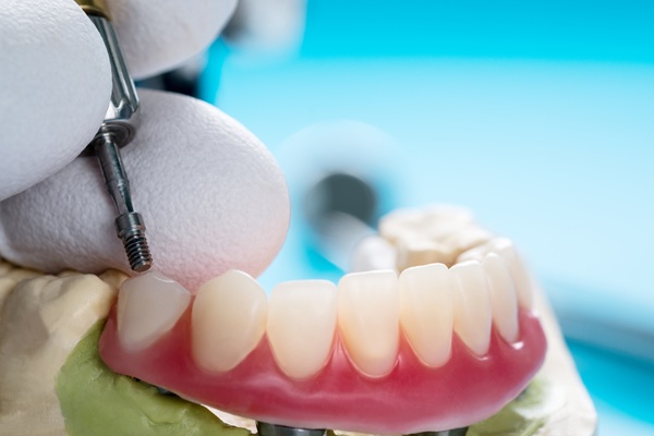 A Guide To The Implant Supported Dentures Procedure