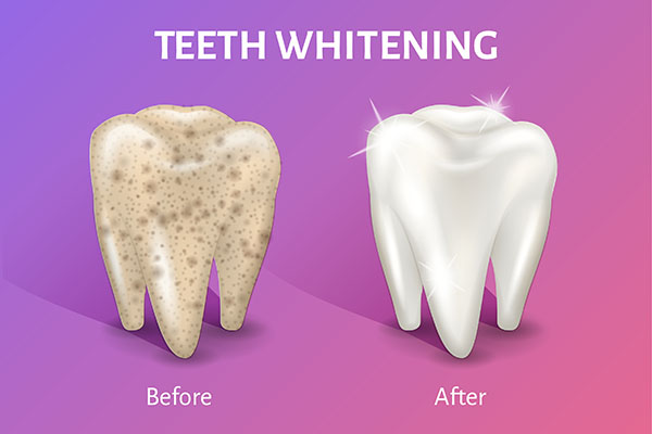 Side Effects of Teeth Whitening Treatments from Novel Smiles in McLean, VA