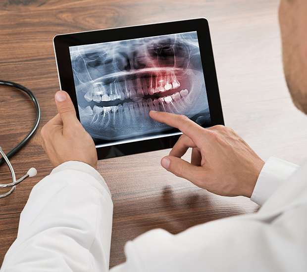 McLean Types of Dental Root Fractures