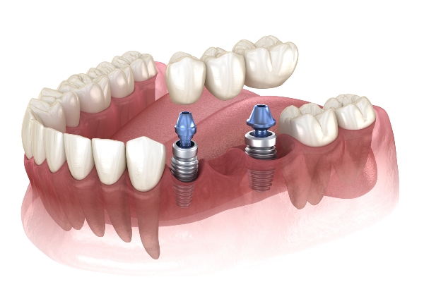 When To Get Dental Implants